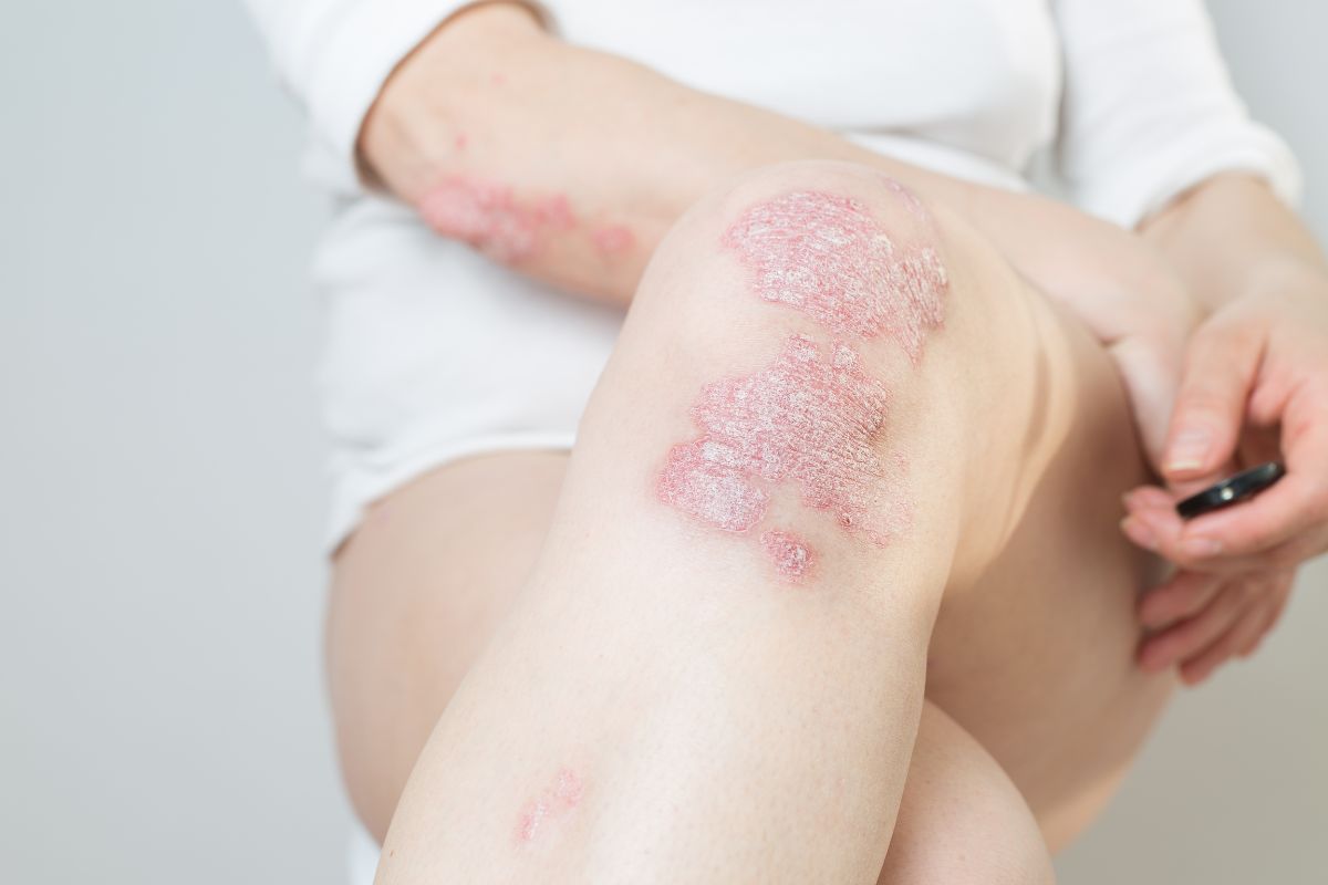 Wanita dengan kondisi Psoriasis Arthritis