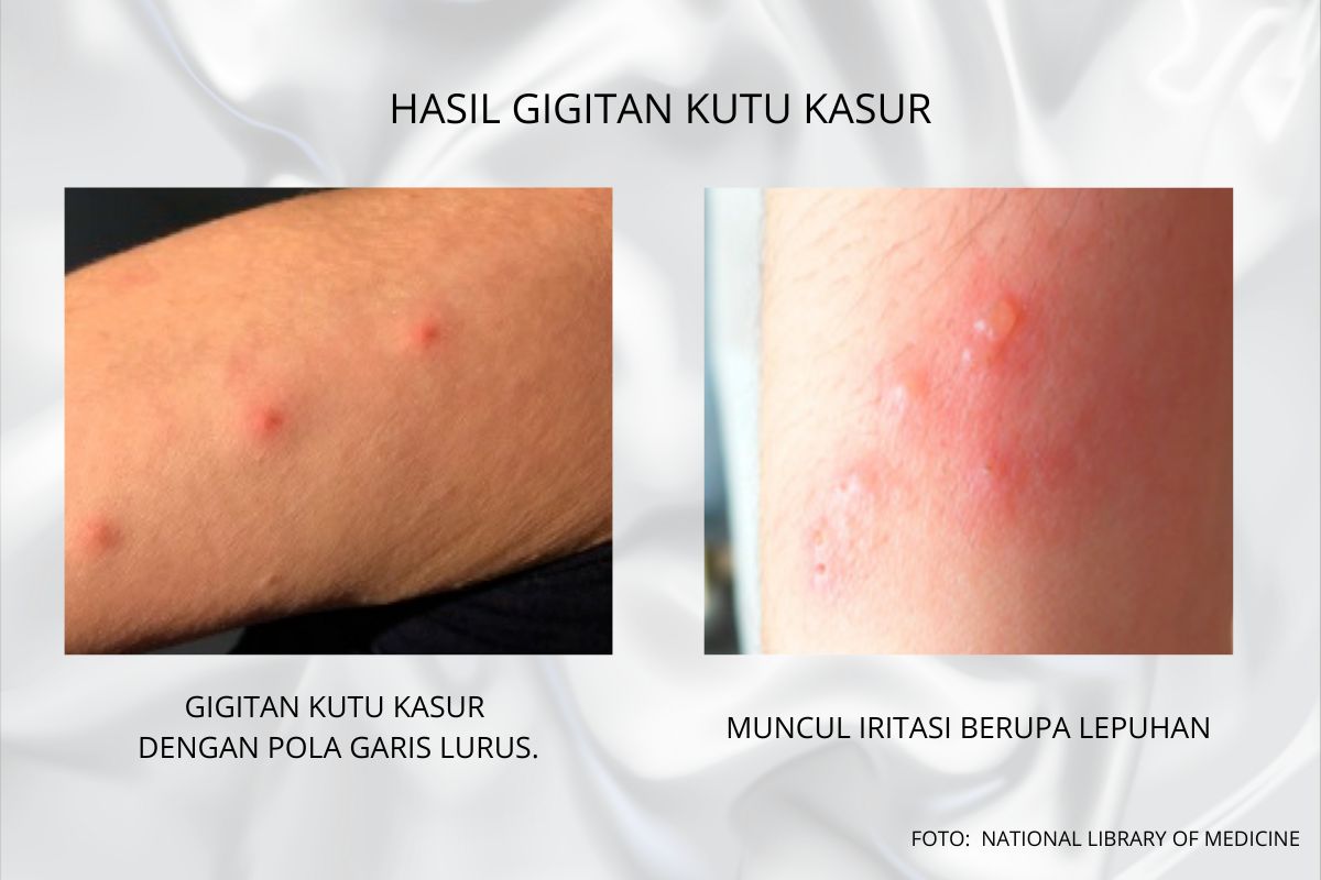 Gigitan kutu kasur dengan pola garis lurus dan lepuhan