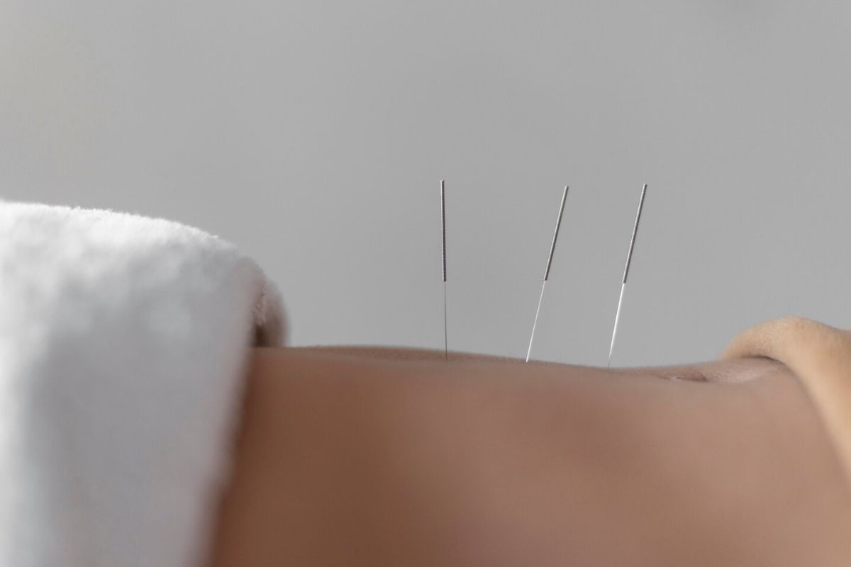 Metode akupuntur