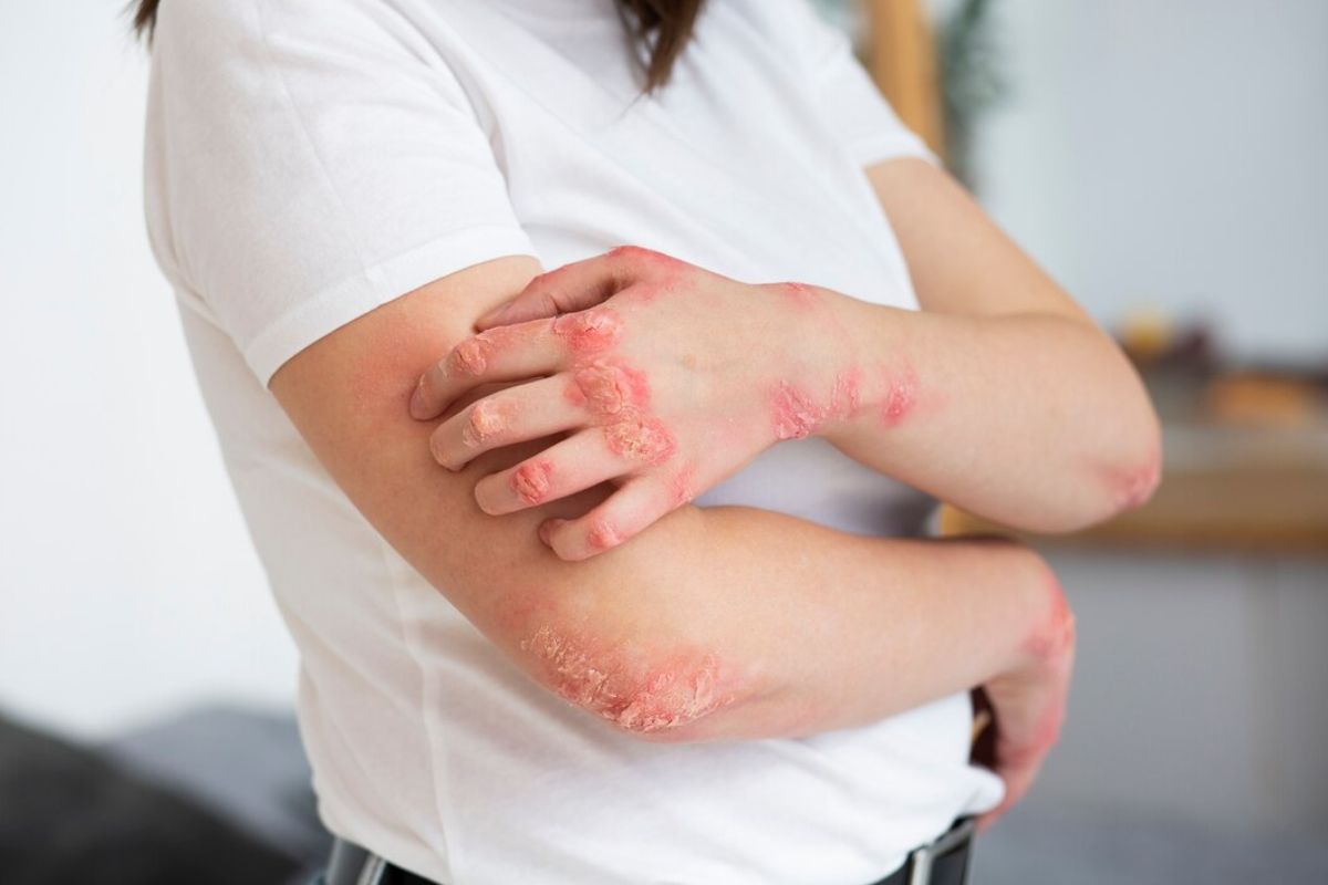 Tangan penderita psoriasis